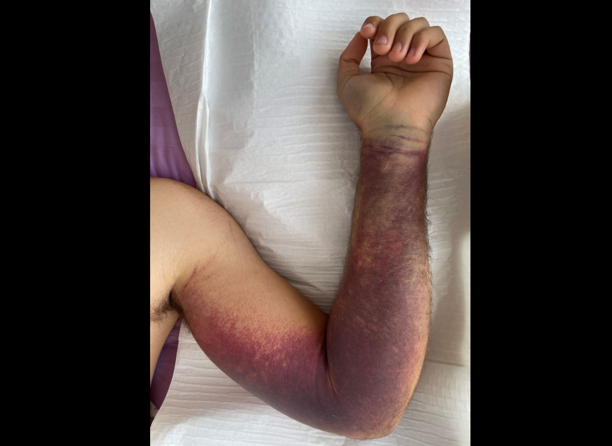 Roka po ugrizu modrasa.Foto: Center za klinično toksikologijo in farmakologijo